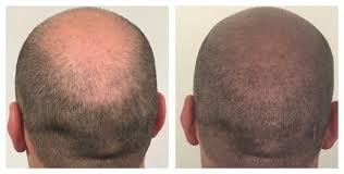 What Are the Advantages of Tricopigmentation & How Much Does It Cost?